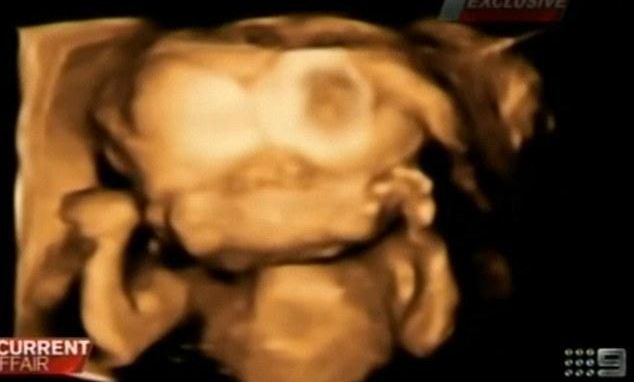 Ce au hotărât după ce au aflat că vor fi părinţii unui copil cu două feţe şi două creiere