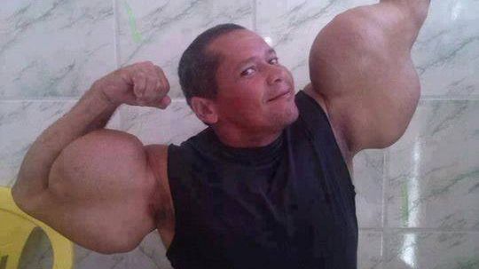 "Popeye din Brazilia" este în pericol de moarte din cauza "mușchilor" săi