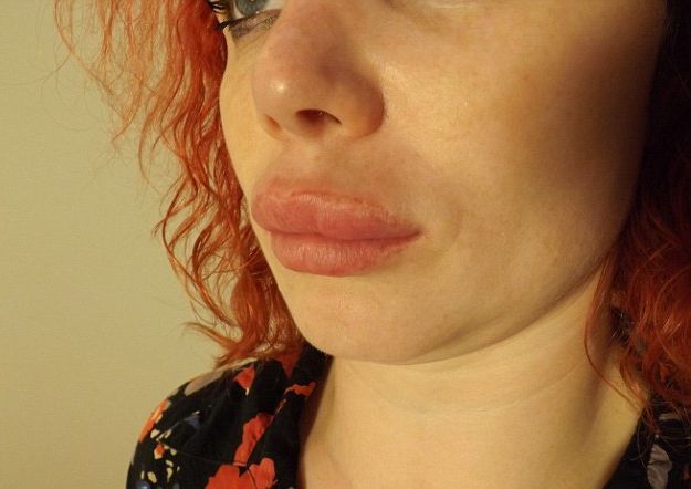 "Am nările ca ale unui porc!" O actriţă a fost desfigurată în urma unei operaţii 