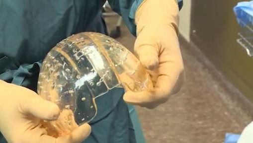 Performanţă uluitoare. Medicii i-au înlocuit unei femei craniul cu un model din plastic