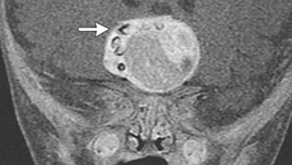 CAZ UNIC ÎN LUME! Ce au descoperit chirurgii americani în creierul unui bebeluş