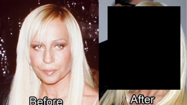 Cele mai nereușite operații estetice 