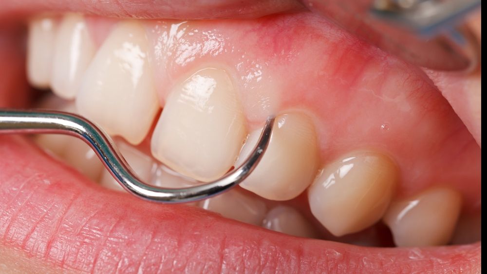 Boala parodontală. Ce este și cum se tratează