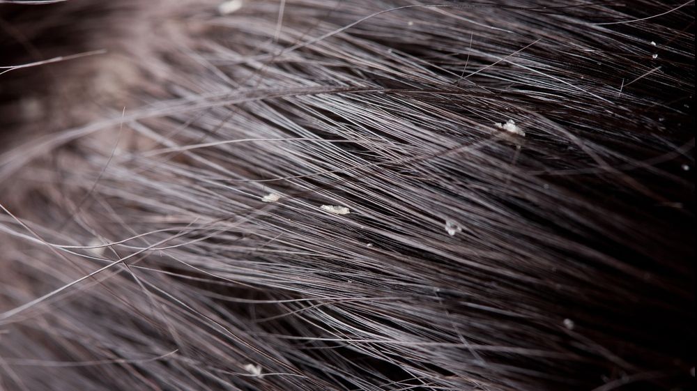 SĂNĂTATE. Cum să scăpați de mătreață