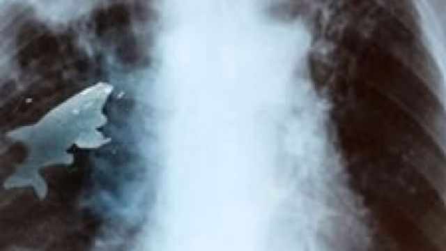 Ce avea acest băiat de 12 ani în PLĂMÂNI a ŞOCAT toţi MEDICII 