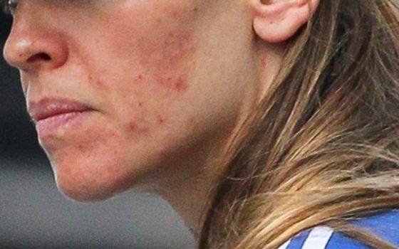 De ce nu e bine să-ți storci coșurile?