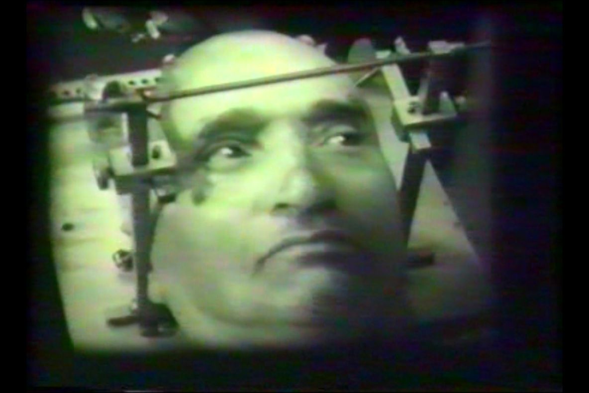 Imagini spectaculoase din timpul PRIMEI OPERAŢII PE CREIER din România. Filmul datează din 1973