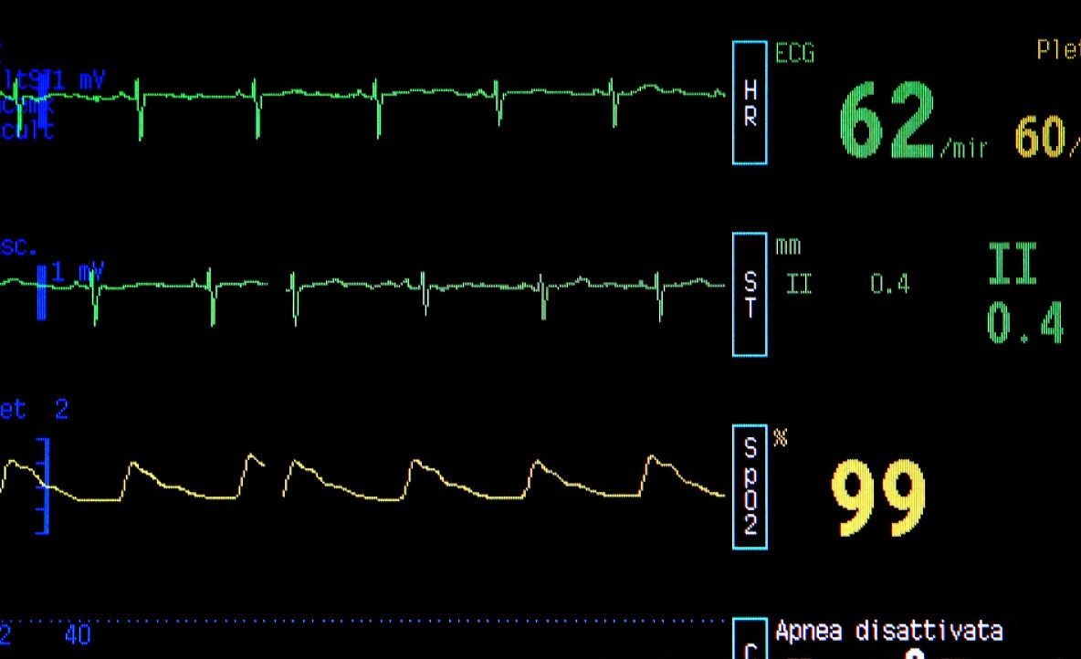 Şi-a deconectat soţia de la aparate, pe patul de spital. După trei zile a primit o veste ŞOCANTĂ