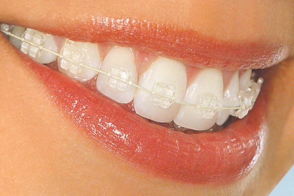 SĂNĂTATE. Aparatul dentar – necesitate sau capriciu?