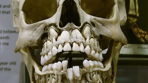 Cel mai bizar craniu. Deşi e şocant, medicii spun că este perfect normal 