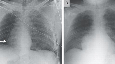 Ce a păţit un bărbat, după un accident de motocicletă. Medicilor nu le-a venit să creadă!