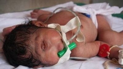 BEBELUSUL CICLOP! MEDICII in stare de SOC cand au vazut cum s-a nascut acest copilas