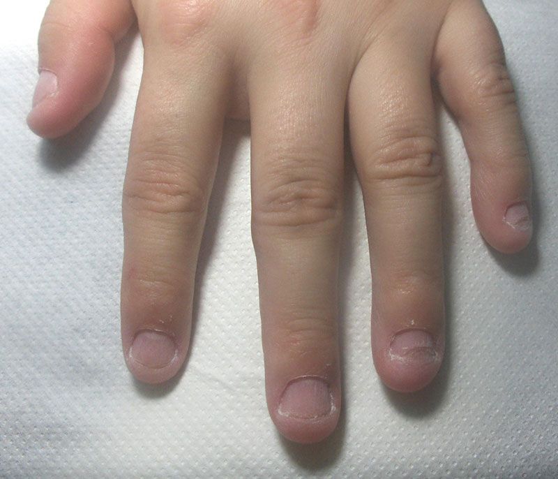 Îţi rozi unghiile? Vezi ce poţi să păţeşti!