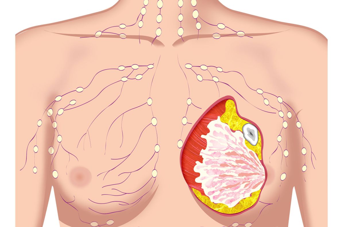 Cum poți reduce riscul apariției cancerului la sân