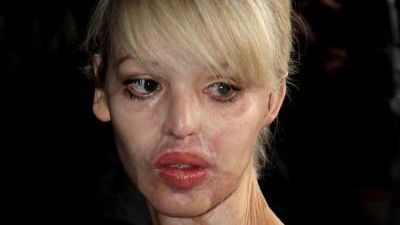 Vedeta desfigurată cu ACID SULFURIC a devenit mămică: "Credeam că nimeni nu o să mă mai iubească"