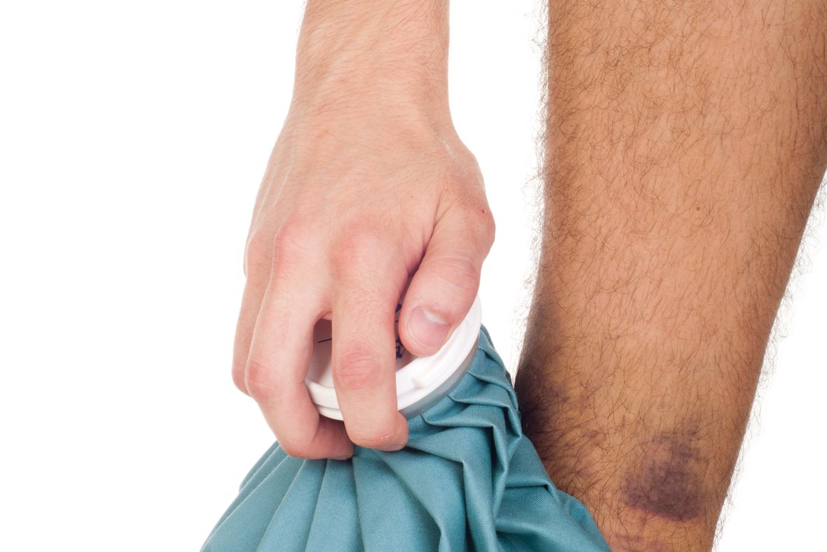 Cele mai bune remedii pentru vânătăi