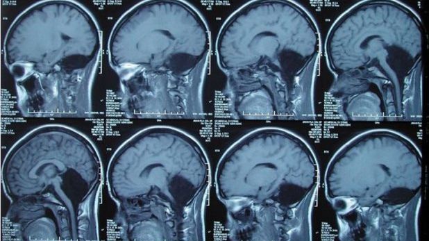 Inexplicabil. A trăit 24 de ani fără creier! Cazul care a uimit medicii