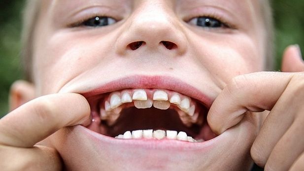 CAZ MEDICAL INCREDIBIL: Copilul cu "DINŢI DE RECHIN"