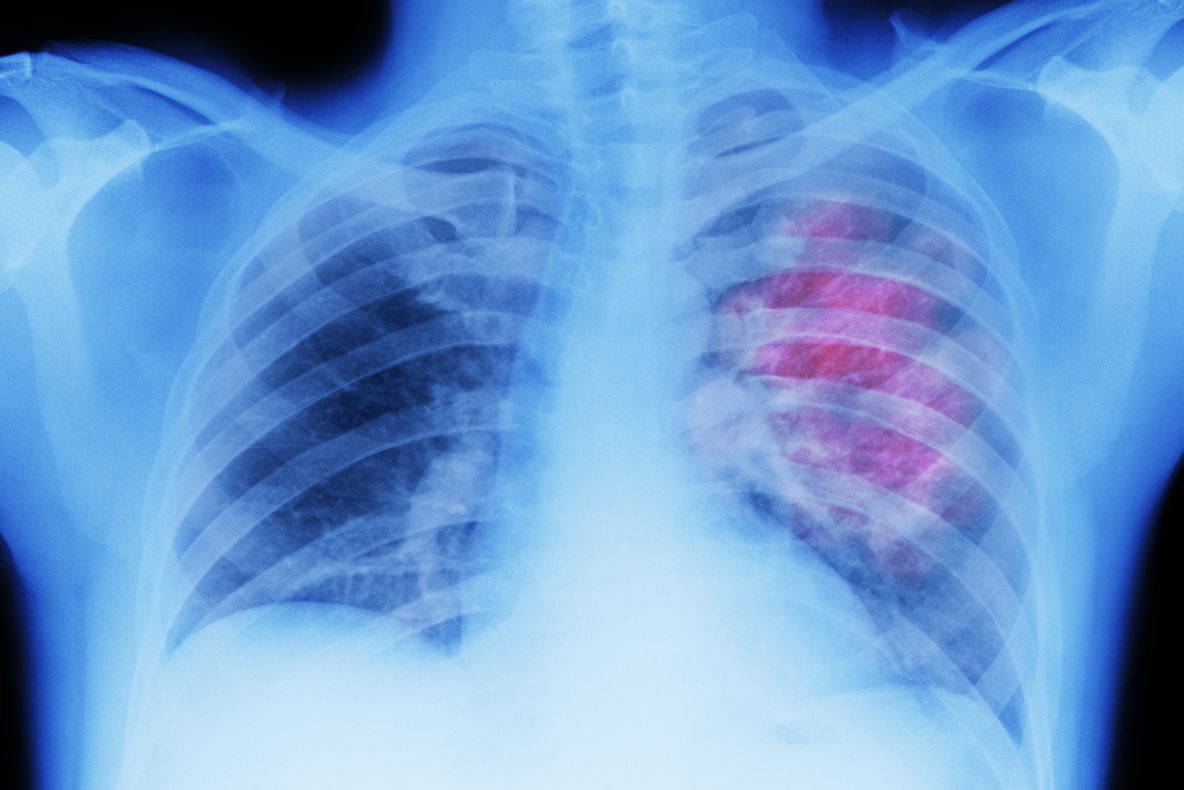 DESCOPERIRE INCREDIBILĂ despre CANCER: Poate rămâne în stare LATENTĂ timp de 20 de ani