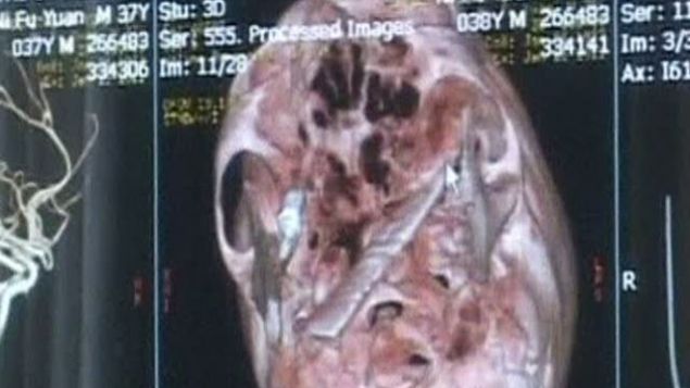 S-a dus la control cu dureri de cap. Medicii AU INGHETAT cand au vazut ce avea IN CRANIU