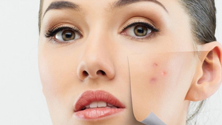 Spune-mi unde îți apar coșuri ca să-ți spun de ce afecțiuni suferi!