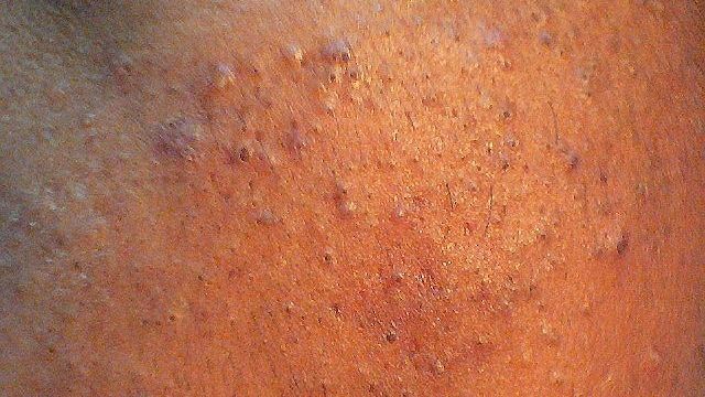 De ce apar, de fapt, punctele negre. Este mai grav decât credeam