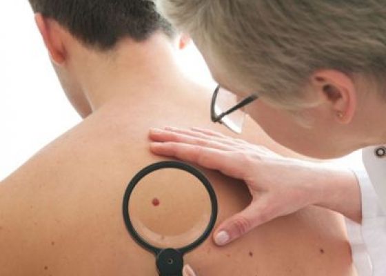 Ce înseamnă fiecare ALUNIȚĂ de pe corp, după medicina orientală