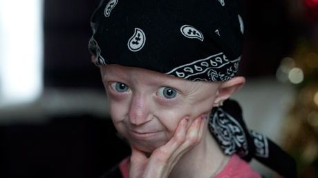 "Adolescenta de 100 de ani" din Marea Britanie a murit la vârsta de 17 ani 