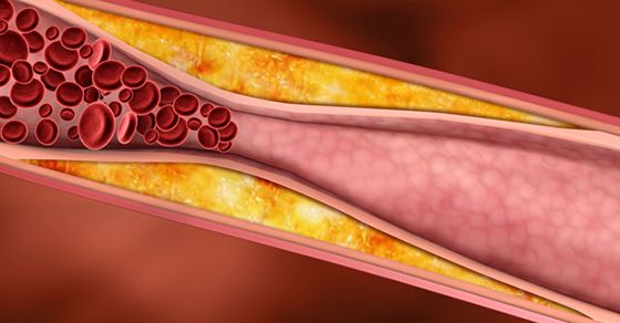 Semne silenţioase care îţi spun că ai arterele înfundate şi că rişti afecţiuni grave