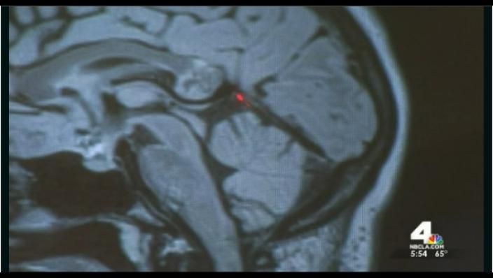Descoperirea şocantă a chirurgului care a operat tumora pe creier a unei femei. Ce era, de fapt