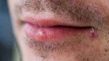 Tot ce trebuie să ştii despre herpes