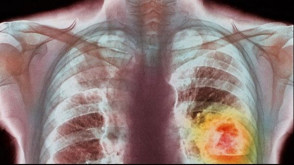 Preparatul pe care îl poți face în casă și care îți curăță plămânii