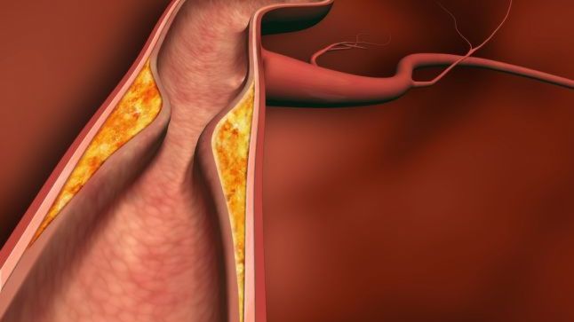 Remediu antic folosit pentru curăţarea arterelor şi reducerea colesterolului din sânge