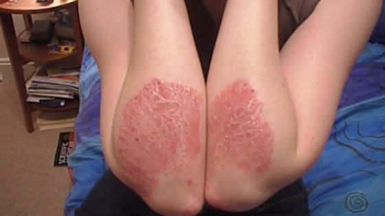Cel mai bun leac natural pentru psoriazis