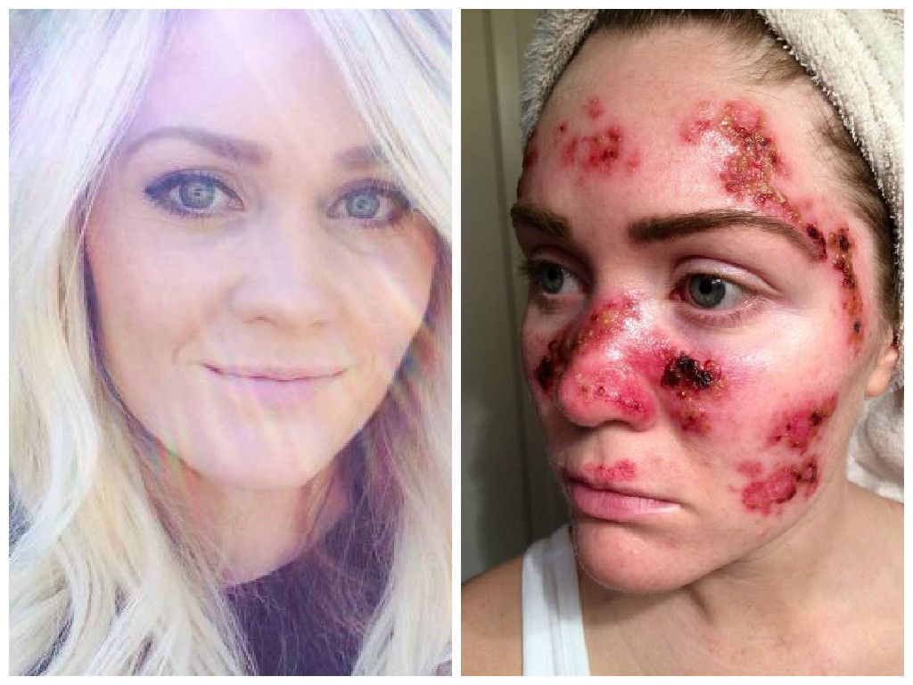 Stătea frecvent la bronzat, până i s-a întâmplat asta. Acum are un sfat pentru întreaga lume