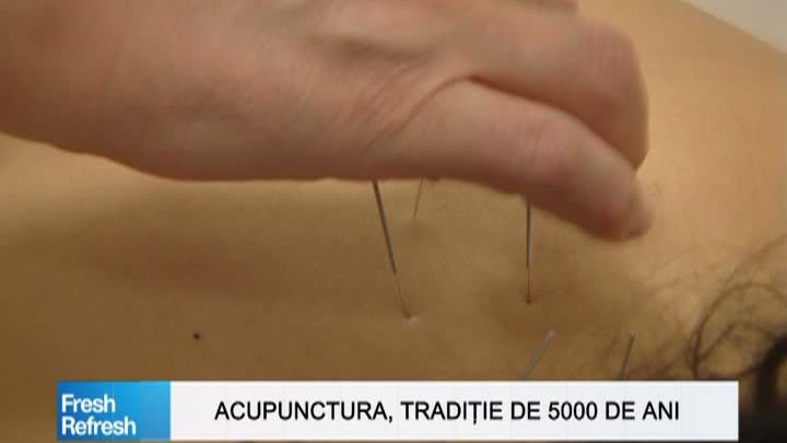 Fresh Refresh. Acupunctura, tradiţie veche de 5000 de ani