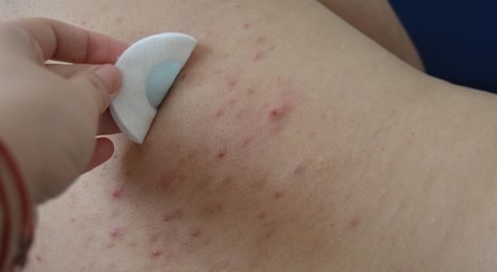 Cum scapi de coșurile de pe spate. Cele mai simple metode naturiste