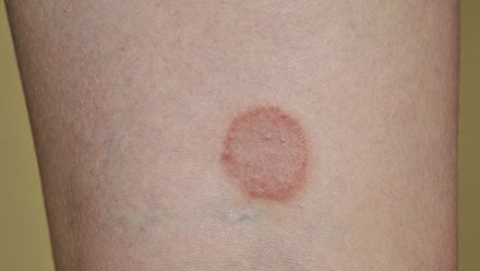 Cele mai comune boli de piele pe care le poți lua vara 