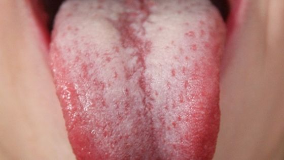 Ai observat că limba ta este albicioasă? Nu mai ignora acest lucru. Uite ce înseamnă