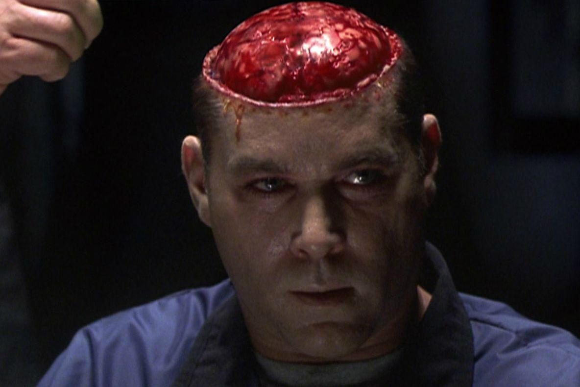 Ce face un pacient în timpul unei operații pe creier. Cum este posibil