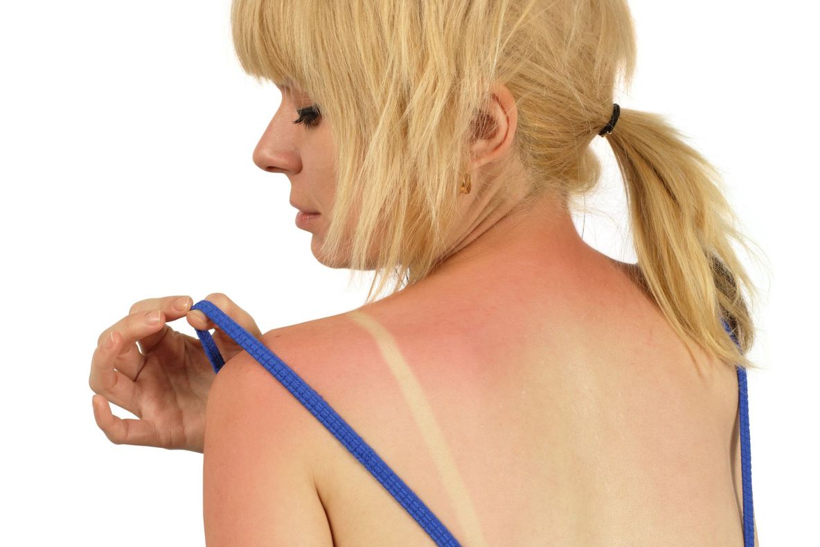 Te-a ars soarele? Iată ce rişti!