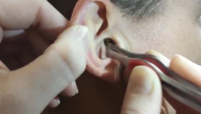 A încremenit! Ce a descoperit în urechea unui bărbat