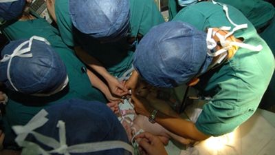 Două surori siameze, separate cu succes într-o operaţie care a folosit tehnologia 3D