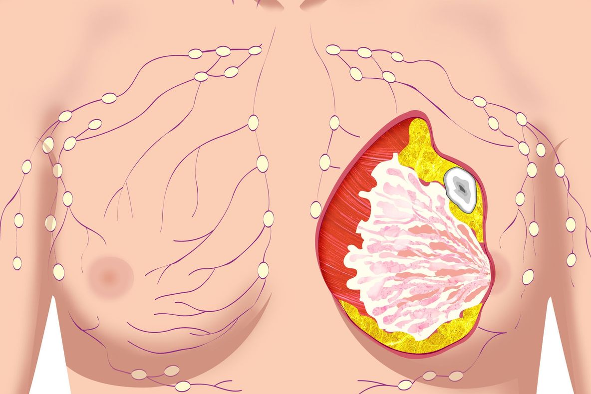 5 simptome atipice ale cancerului mamar
