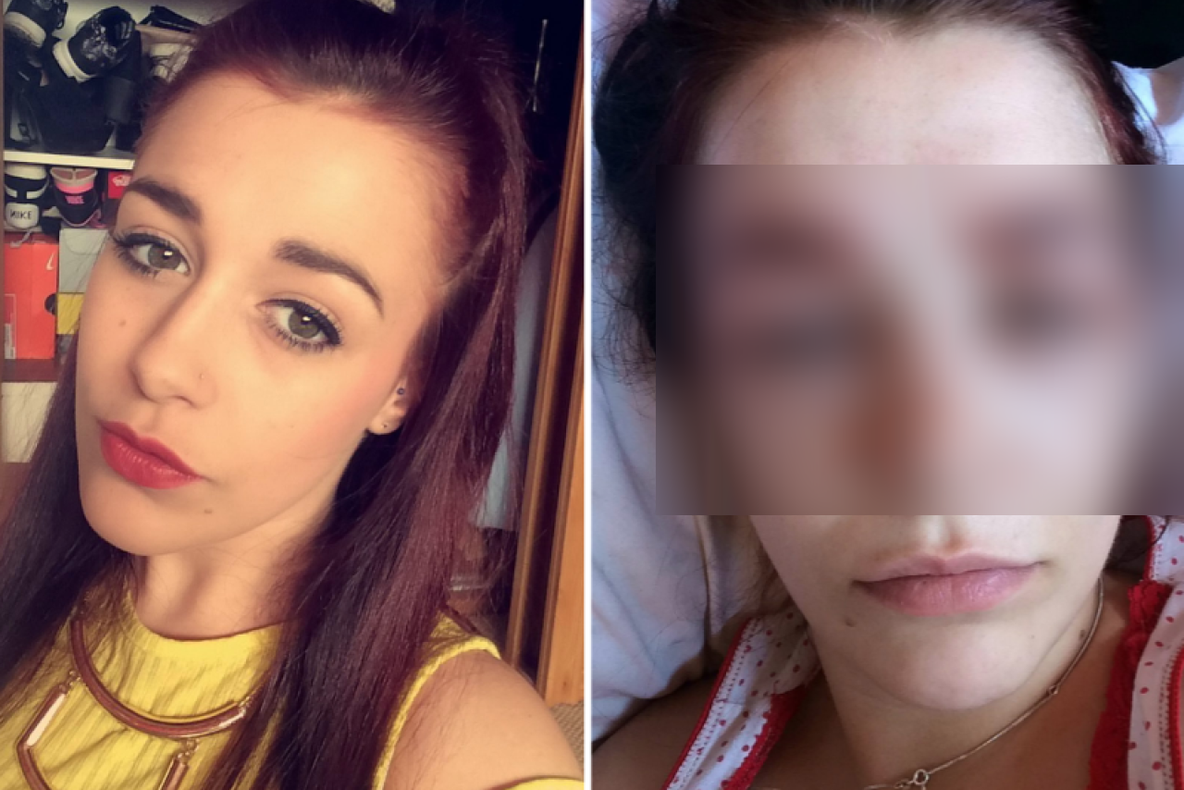 Şi-a dorit sprâncene mai groase, dar rezultatul a desfigurat-o: reacţie alergică de coşmar 