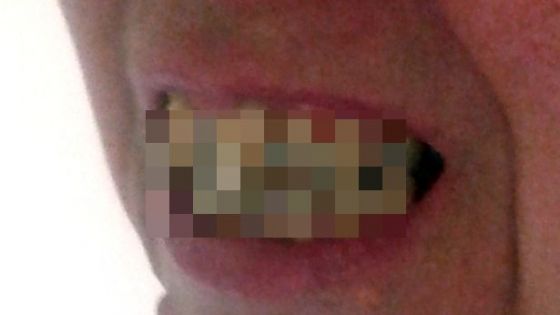 Îi este ruşine să mai iasă din casă după ce a observat ce îi creşte în gură! Medicii au fost şocaţi