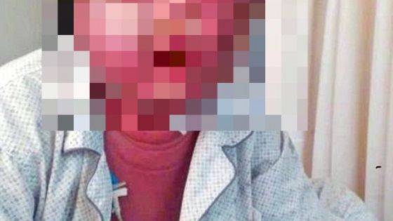 E incredibil cum arată acum faţa acestui bărbat după ce a fost înţepat de un ţânţar