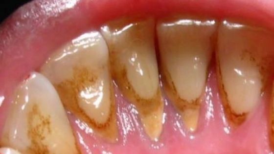 Scapă de tartru cu un singur ingredient chiar la tine acasă! E atât de simplu 