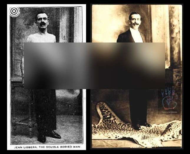 Povestea adevărată a șocat o lume întreagă. Și-a trăit viața cu un frate "parazit" lipit de stomac