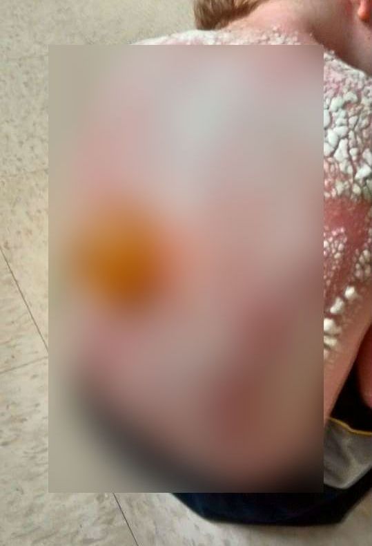 Ce a pățit un copil lăsat fără tricou în plin soare, fără cremă de protecție. Imaginea este șocantă